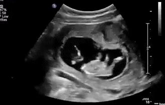 怀孕六个月，胎儿总是用屁股顶肚皮，为什么？