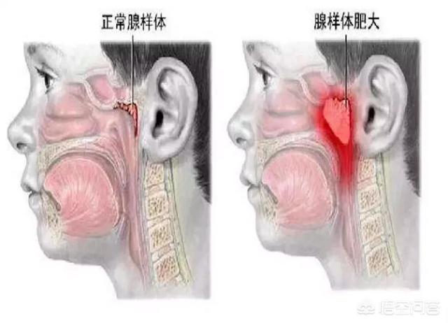 两周岁小宝宝睡觉打呼噜怎么办？